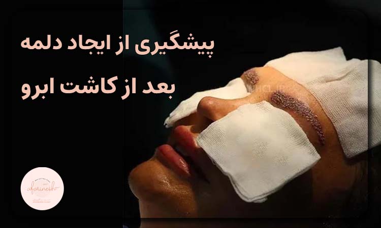 پیشگیری از دلمه بعد کاشت ابرو