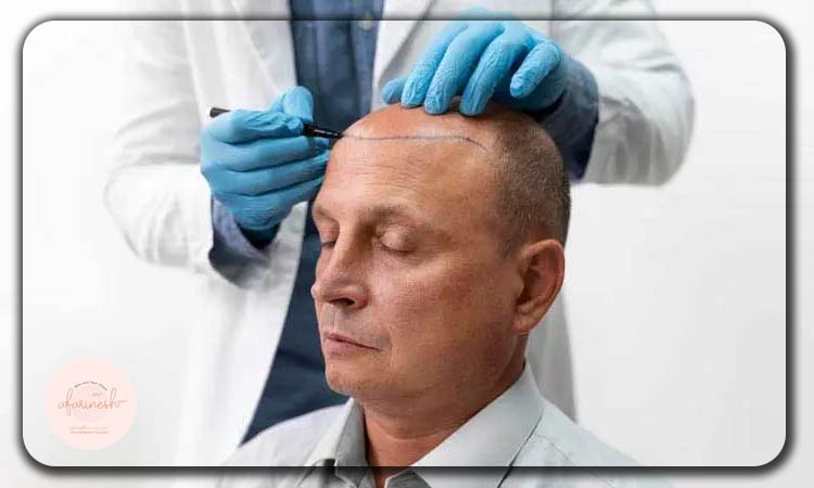 انجام کاشت مو به روش fit