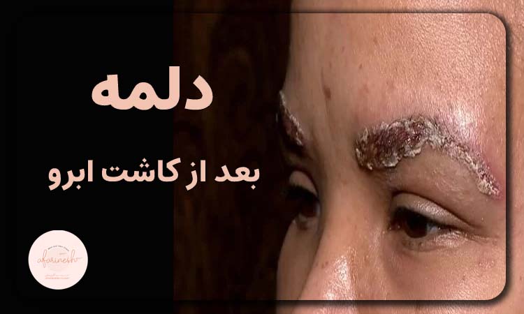 دلمه بعد از کاشت ابرو
