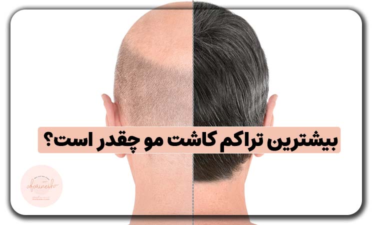 بیشترین تراکم کاشت مو چقدر است؟