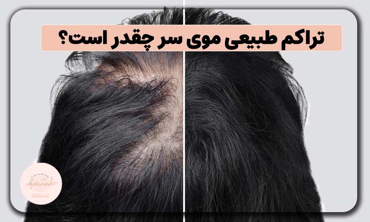 تراکم طبیعی موی سر چقدر است؟