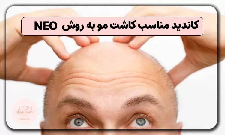 کاندیدای کاشت مو به روش neo