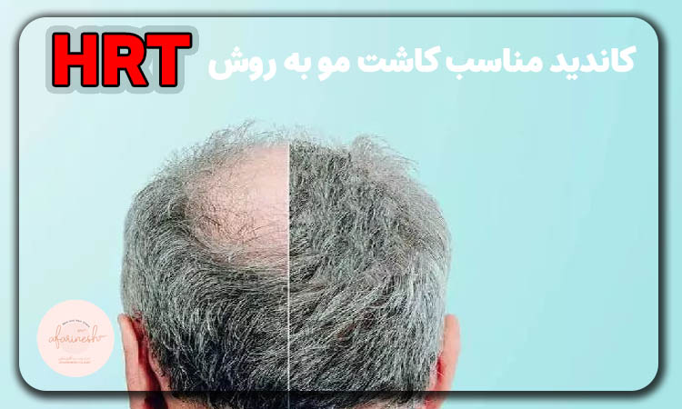 کاندید کاشت مو به روش hrt