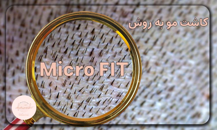 کاشت مو به روش Micro FIT