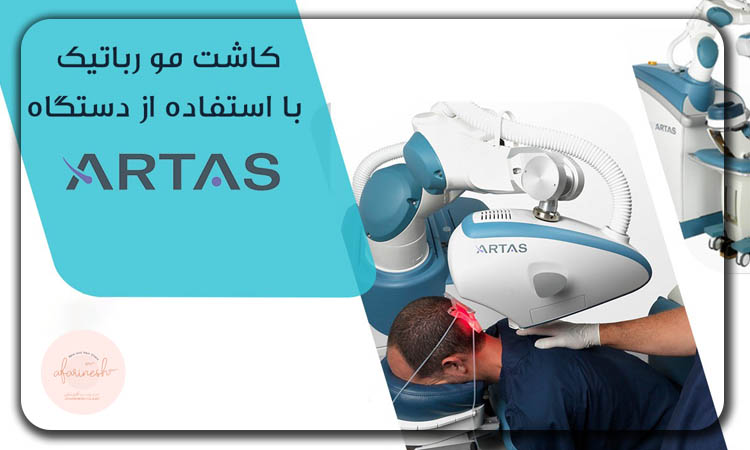 کاشت مو به روش رباتیک