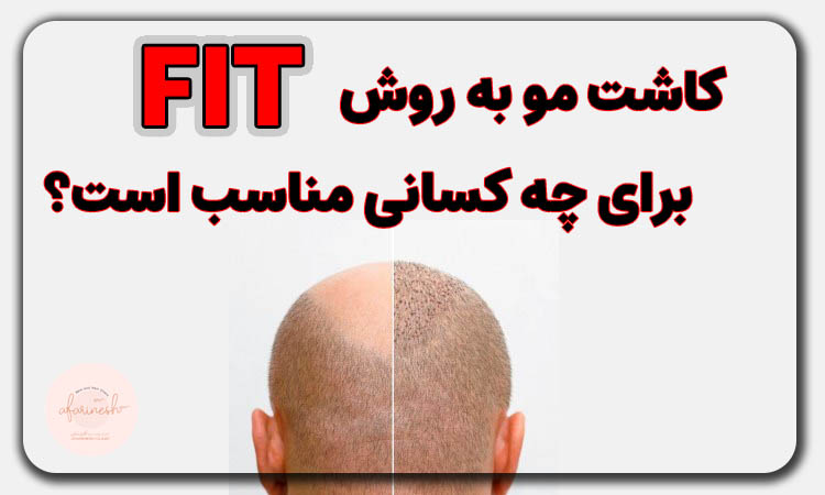 کاندیدای کاشت مو به روش fit