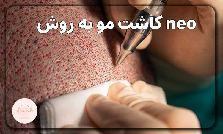 کاشت مو به روش نیوگرافت
