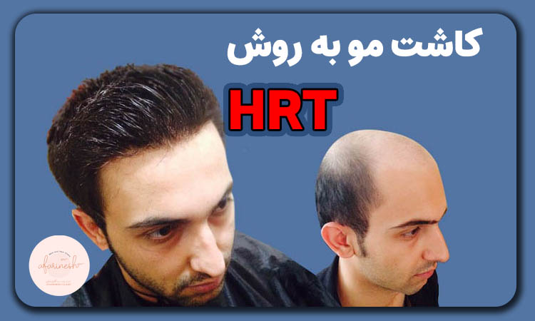 ترمیم مو به روش hrt