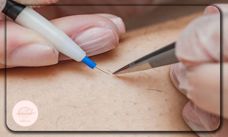 جایگزین کاشت مو از ناحیه تناسلی