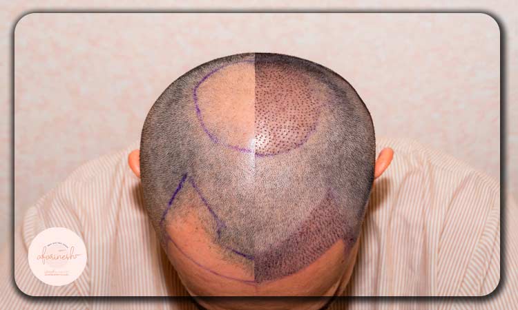 روشهای کاشت مو بدون نیاز به بانک مو