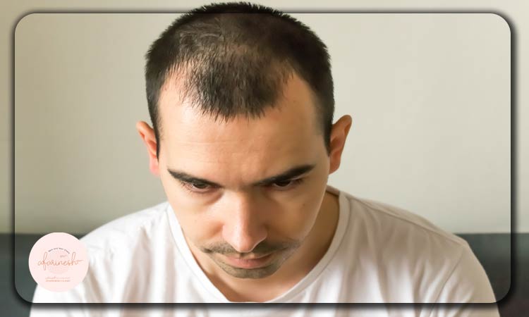 عوارض کاشت مو به روش BHT