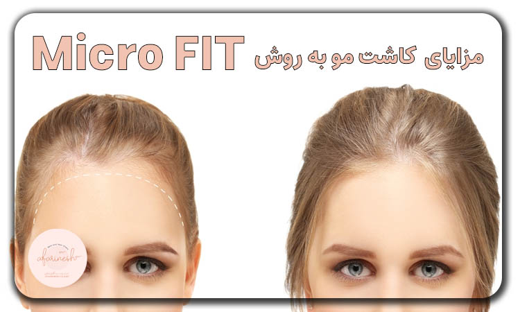 مزایای کاشت مو Micro FIT