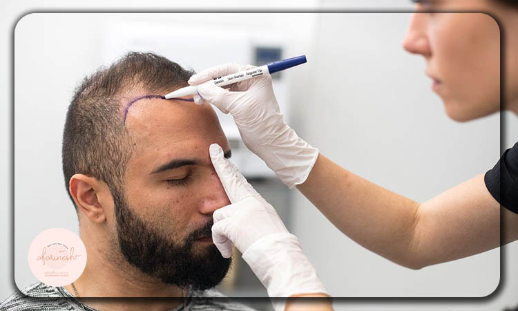کاندیدای برای کاشت مو به روش bht