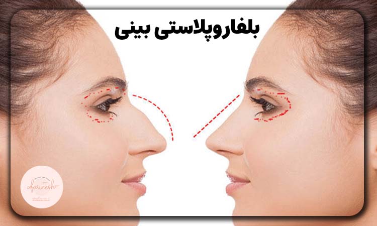 عوارض بلفاروپلاستی بینی