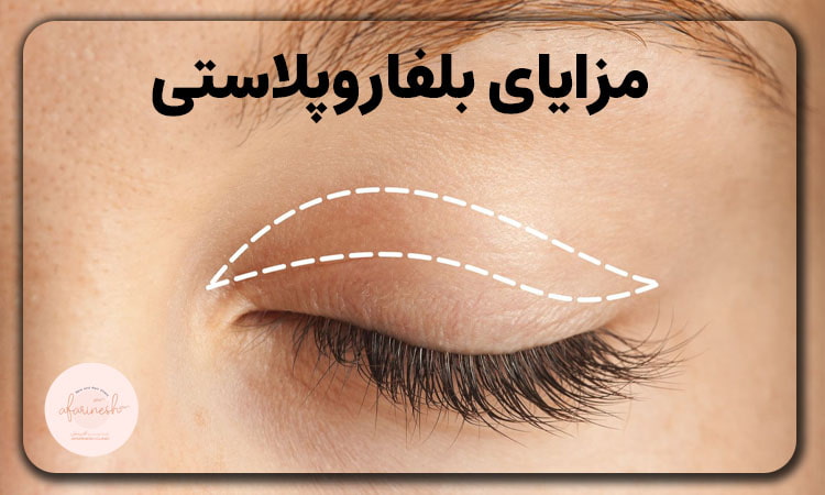 مزایای بلفاروپلاستی
