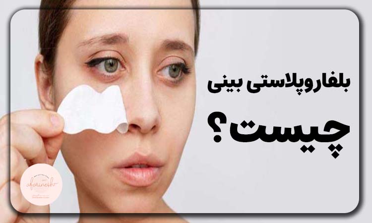 بلفاروپلاستی بینی چیست