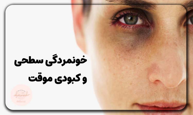 خونمردگی سطحی و کبودی موقت