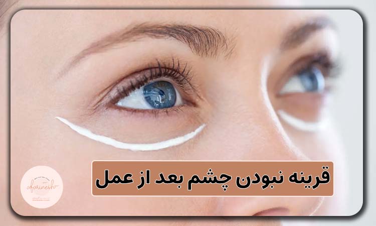 قرینه نبودن چشم بعد از عمل