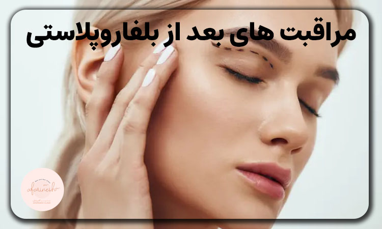 مراقبت های بعد از بلفاروپلاستی