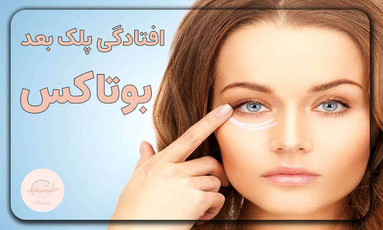 افتادگی پلک بعد از بوتاکس