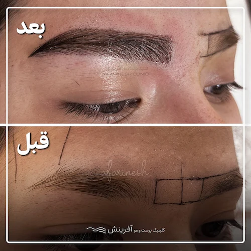 قبل و بعد کاشت ابرو طبیعی در کلینیک پوست و مو آفرینش