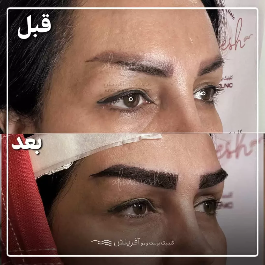 قبل و بعد از کاشت ابرو طبیعی