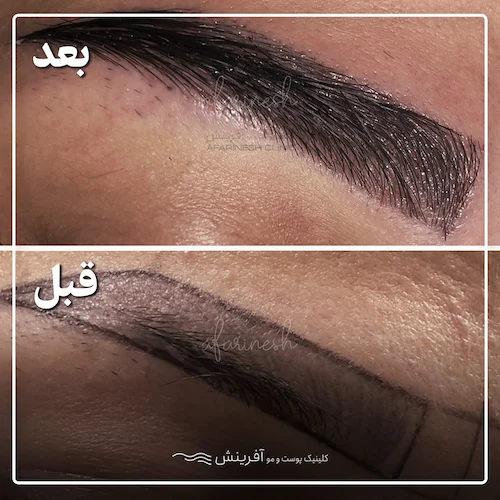 تصویر کاشت ابرو