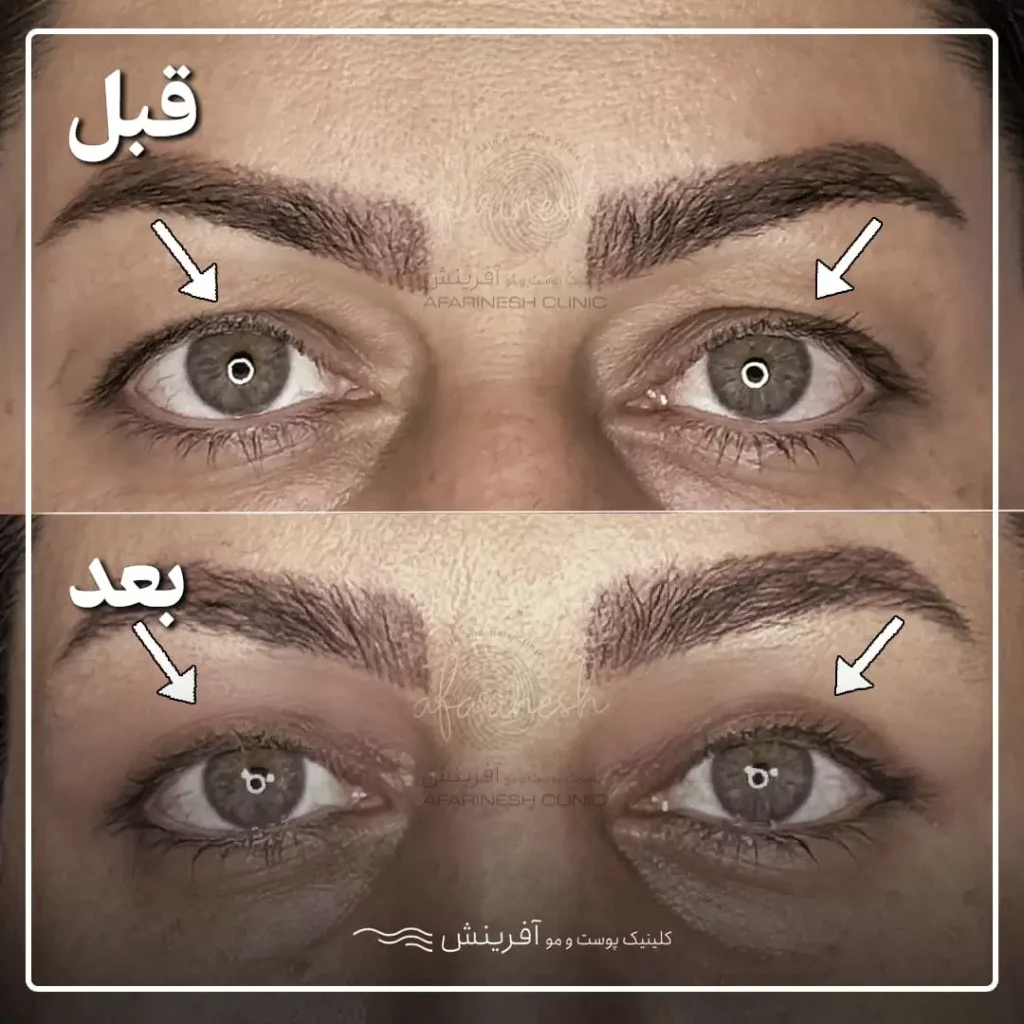 قبل و بعد از بلفاروپلاستی