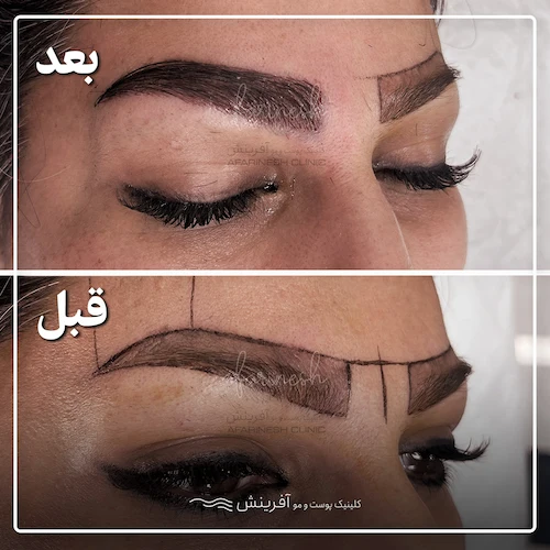 قبل و بعد از کاشت ابرو طبیعی در آفرینش
