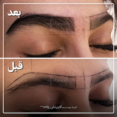 قبل و بعد از کاشت ابرو در تصویر