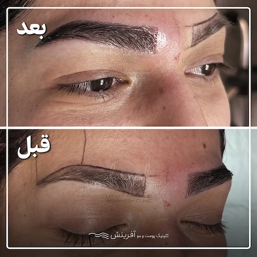 بعد از کاشت ابرو در کلینیک آفرینش