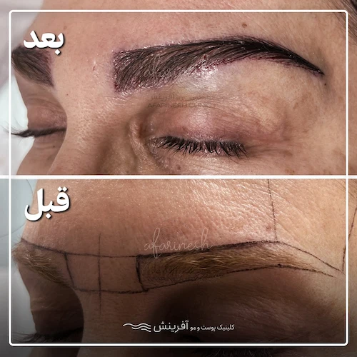 کاشت ابرو طبیعی و کادردار