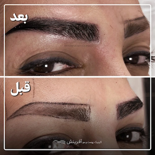 مدل قبل و بعد کاشت ابرو