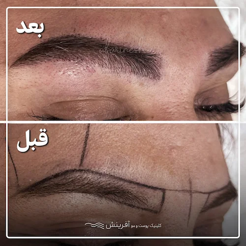 قبل و بعد از کاشت در یک نگاه
