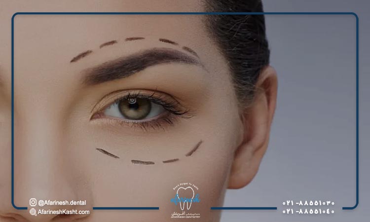 هزینه جراحی افتادگی پلک