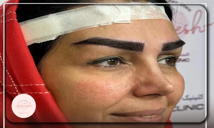 جدیدترین روش کاشت ابرو