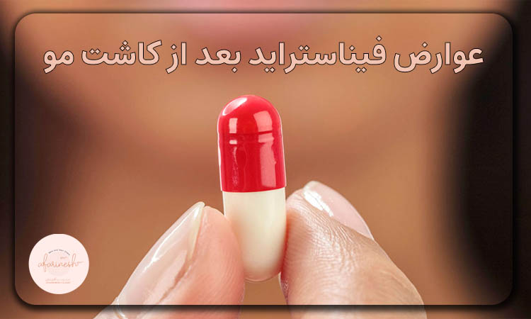 عوارض فیناستراید بعد از کاشت مو