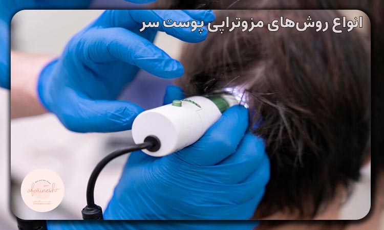 انواع روش‌های مزوتراپی پوست سر