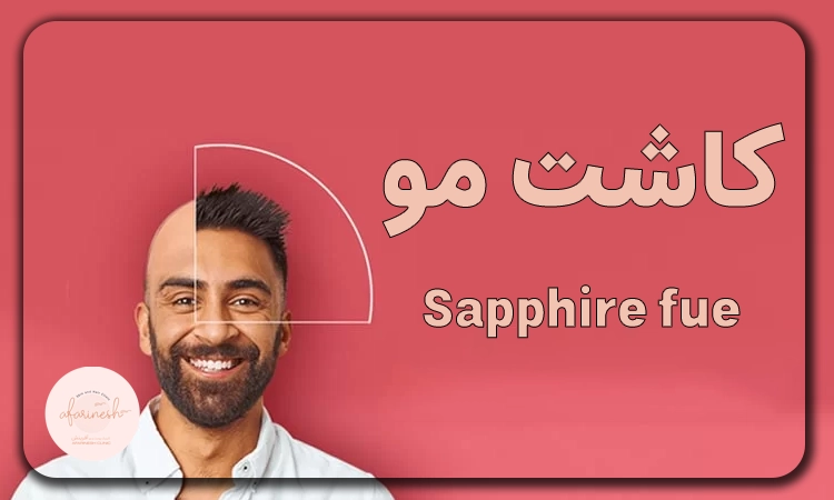 کاشت مو به روش sapphire fue