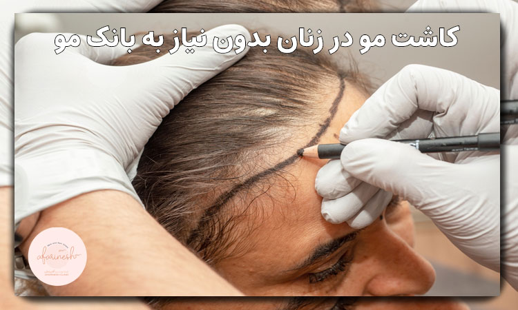 کاشت مو در زنان بدون نیاز به بانک مو