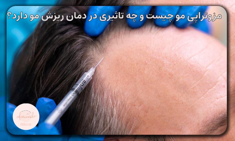 مزوتراپی مو چیست و چه تاثیری در درمان ریزش مو دارد؟