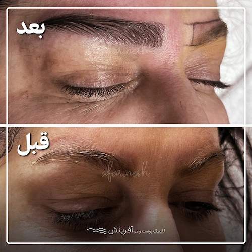 تصاویر قبل و بعد از کاشت ابرو