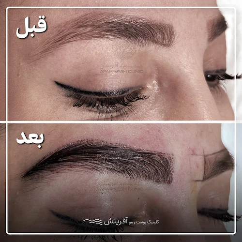قبل و بعد کاشت ابرو نچرال
