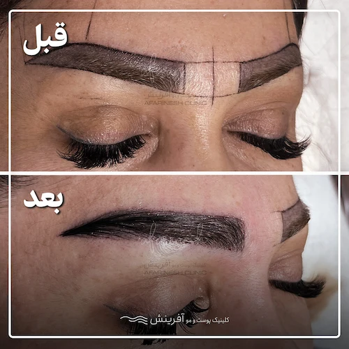 قبل و بعد کاشت ابرو نچرال