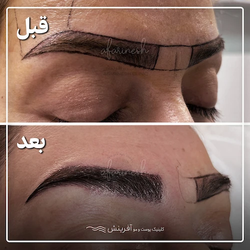 قبل و بعد از کاشت ابرو طبیعی