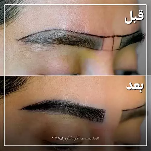 قبل و بعد از کاشت ابرو طبیعی