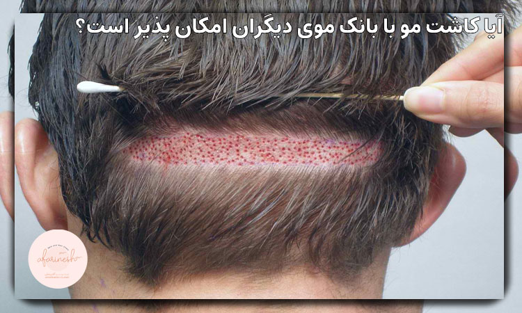 آیا کاشت مو با بانک موی دیگران امکان پذیر است؟