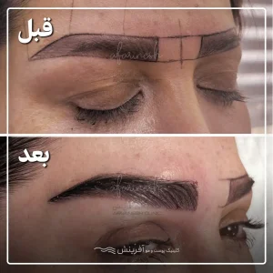 عکس کاشت مو در درناحیه ابرو