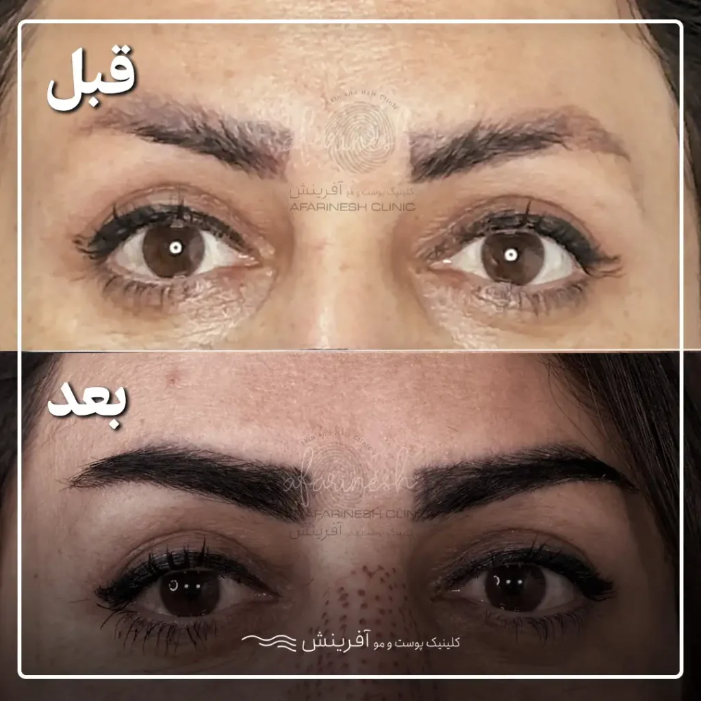 عکس قبل و بعد کاشت ابرو روی تاتو