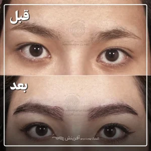 عکس کاشت ابرو قبل و بعد